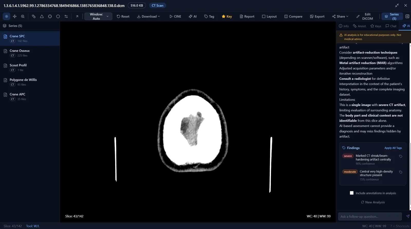 AI-assisted finding flags in the BigMind Medical viewer, surfaced for clinician review